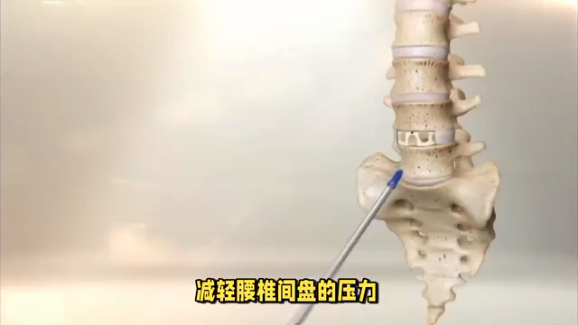 鐵腰板治療腰間盤突出管用,效果顯著不反彈