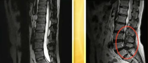 腰突 腰肌勞損 風濕性腰痛,找準一個穴位,每天一貼,貼出鐵腰板兒,從此不再飽受疼痛折磨...