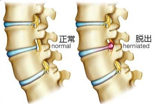 鐵腰板真的有效果嗎 骨病患者如何選擇